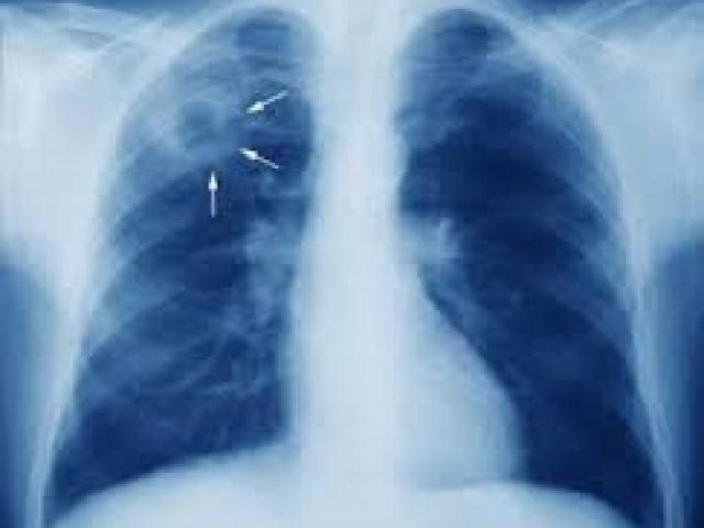 TB affected lungs