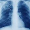 TB affected lungs